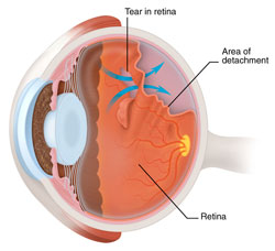 torn retina healing time